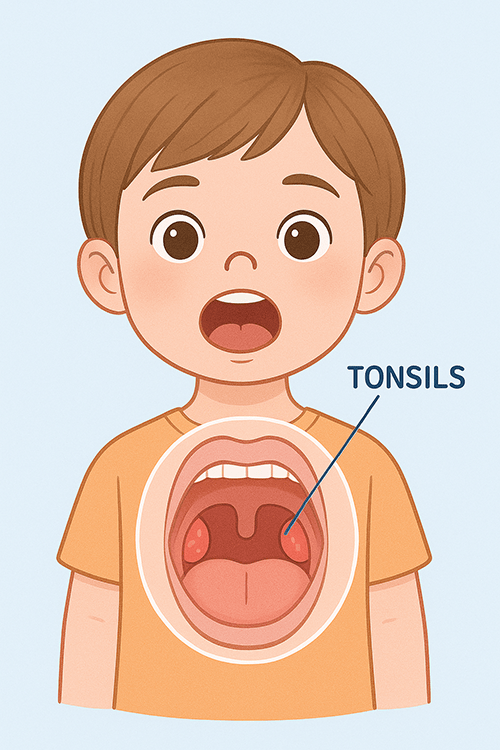 ilustracion-amigdalas-inflamadas-en-ninos-explicacion-cirugia-min